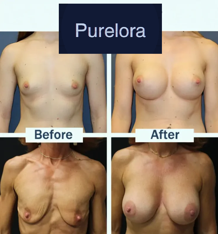 【Official Flagship Store】Targeted Breast Enhancement Advanced Nano Microneedle Patch