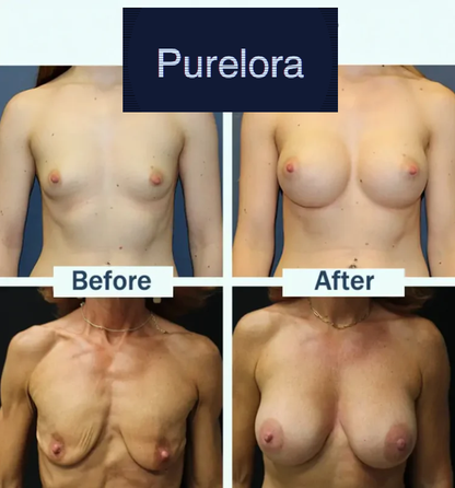 【Official Flagship Store】Targeted Breast Enhancement Advanced Nano Microneedle Patch
